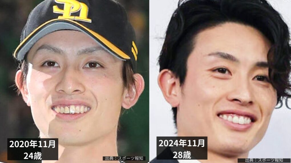 周東佑京選手の歯の白さ比較画像